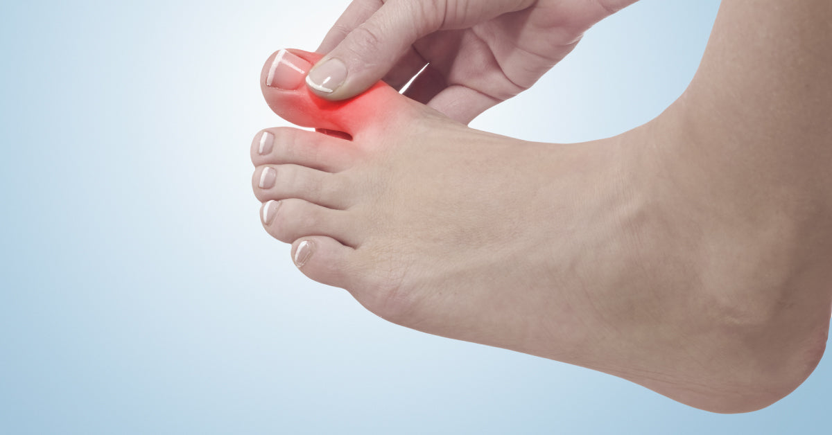 Causes Of Gout And Effective Treatment