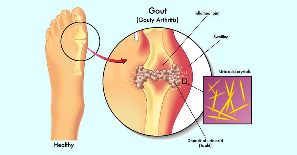 Natuurlike "Gout" Behandeling